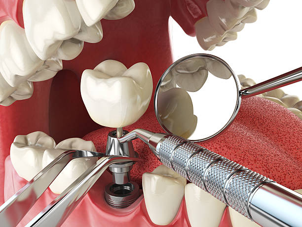 Best Emergency Root Canal Therapy in Templeton, CA